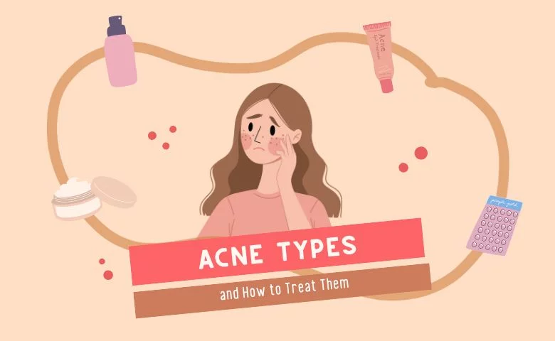 Acne Types and How to Treat Them